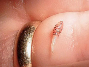 Фото. Ежегодно врачи извлекают десятки червей и личинок из под кожи пациентов